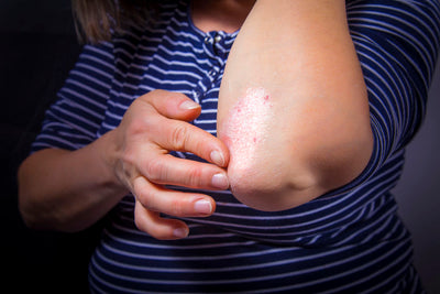 Psoriasis Causes and How to Control Symptoms