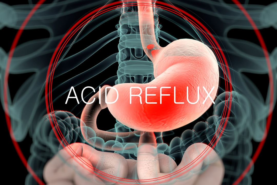 Acid Reflux